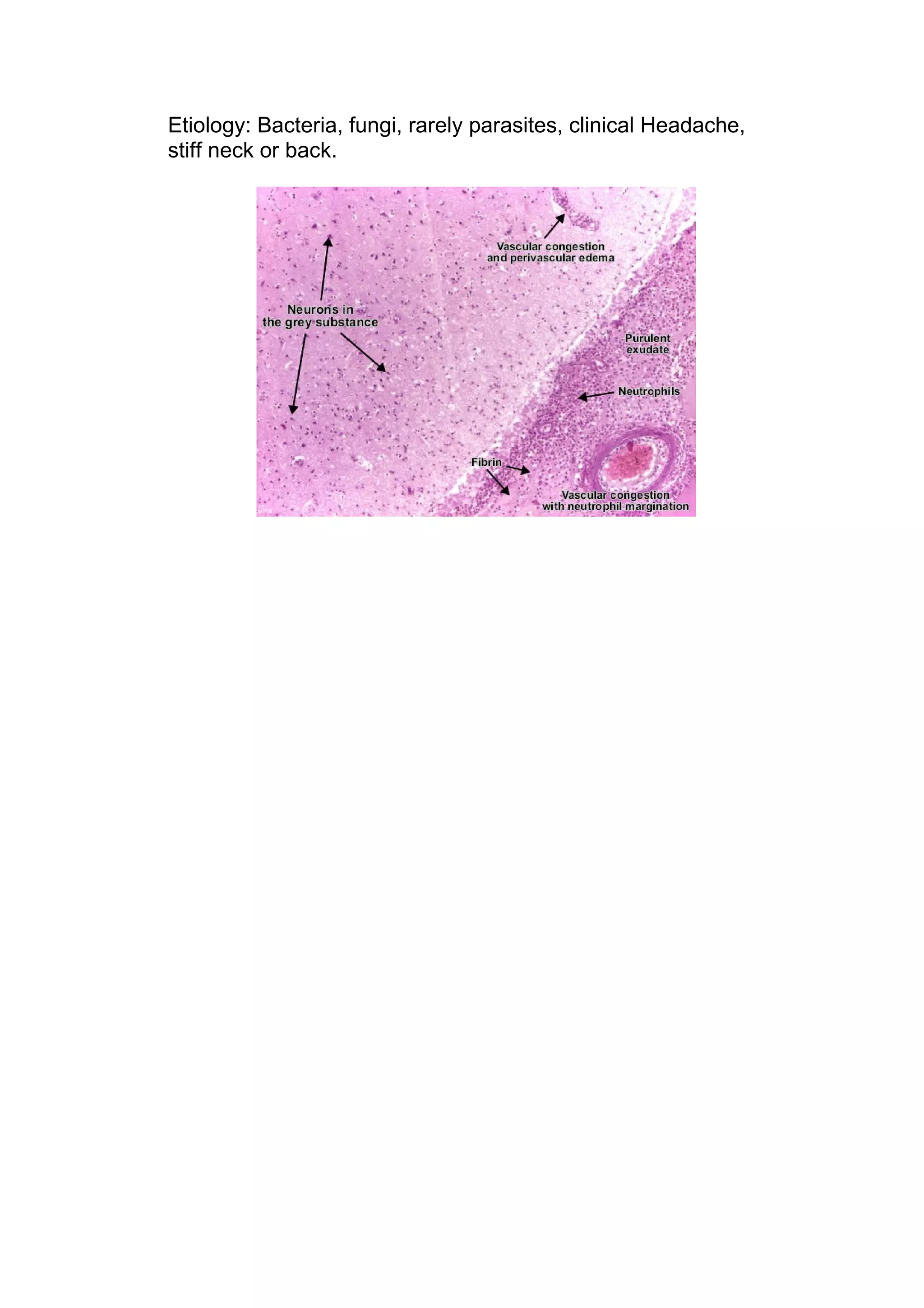 Etiology: Bacteria, fungi, rarely parasites, clinical Headache,
stiff neck or back.
 