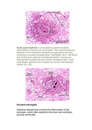 Acute pyelonephritis is an exudative purulent localized
inflammation of kidney and renal pelvis. The renal parenchyma
presents in the interstitium abscesses (suppurative necrosis),
consisting in purulent exudate (pus): neutrophils, fibrin, cell debris
and central germ colonies (hematoxylinophils). Tubules are
damaged by exudate and may contain neutrophil casts. In the
early stages, glomeruli and vessels are normal. (Hematoxylin-
eosine, ob. x10)




Purulent meningitis

Infectious disease that involves the inflammation of the
meninges, which often extends to the brain and ventricles,
causing ventriculitis.
 