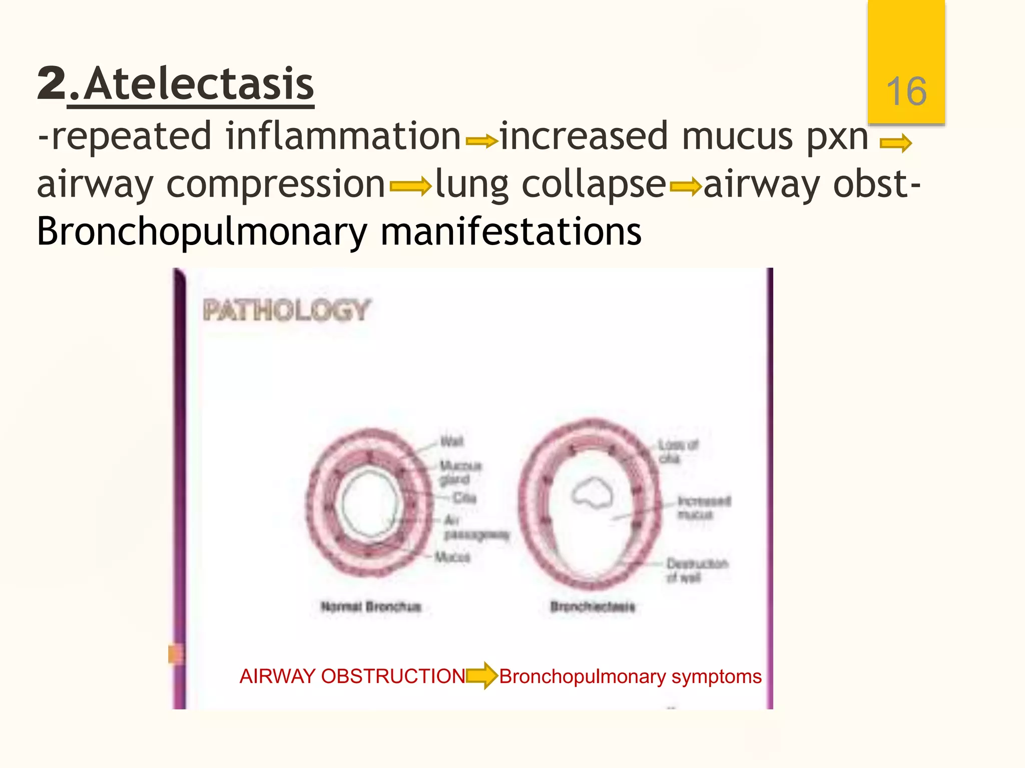 2.Atelectasis
-repeated inflammation increased mucus pxn
airway compression lung collapse airway obst-
Bronchopulmonary manifestations
16
AIRWAY OBSTRUCTION Bronchopulmonary symptoms
 
