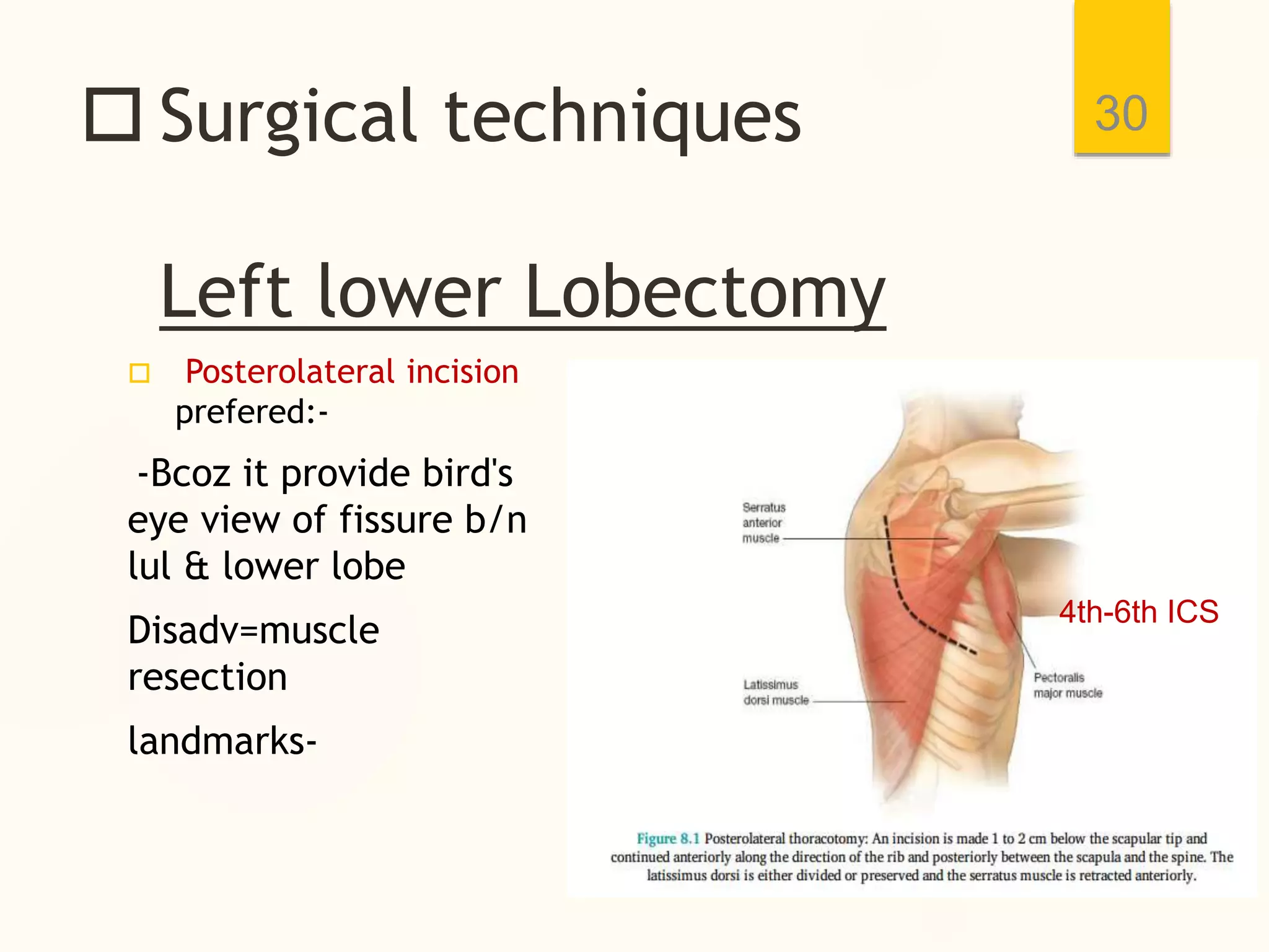  Surgical techniques
Left lower Lobectomy
 Posterolateral incision
prefered:-
-Bcoz it provide bird's
eye view of fissure b/n
lul & lower lobe
Disadv=muscle
resection
landmarks-
30
4th-6th ICS
 