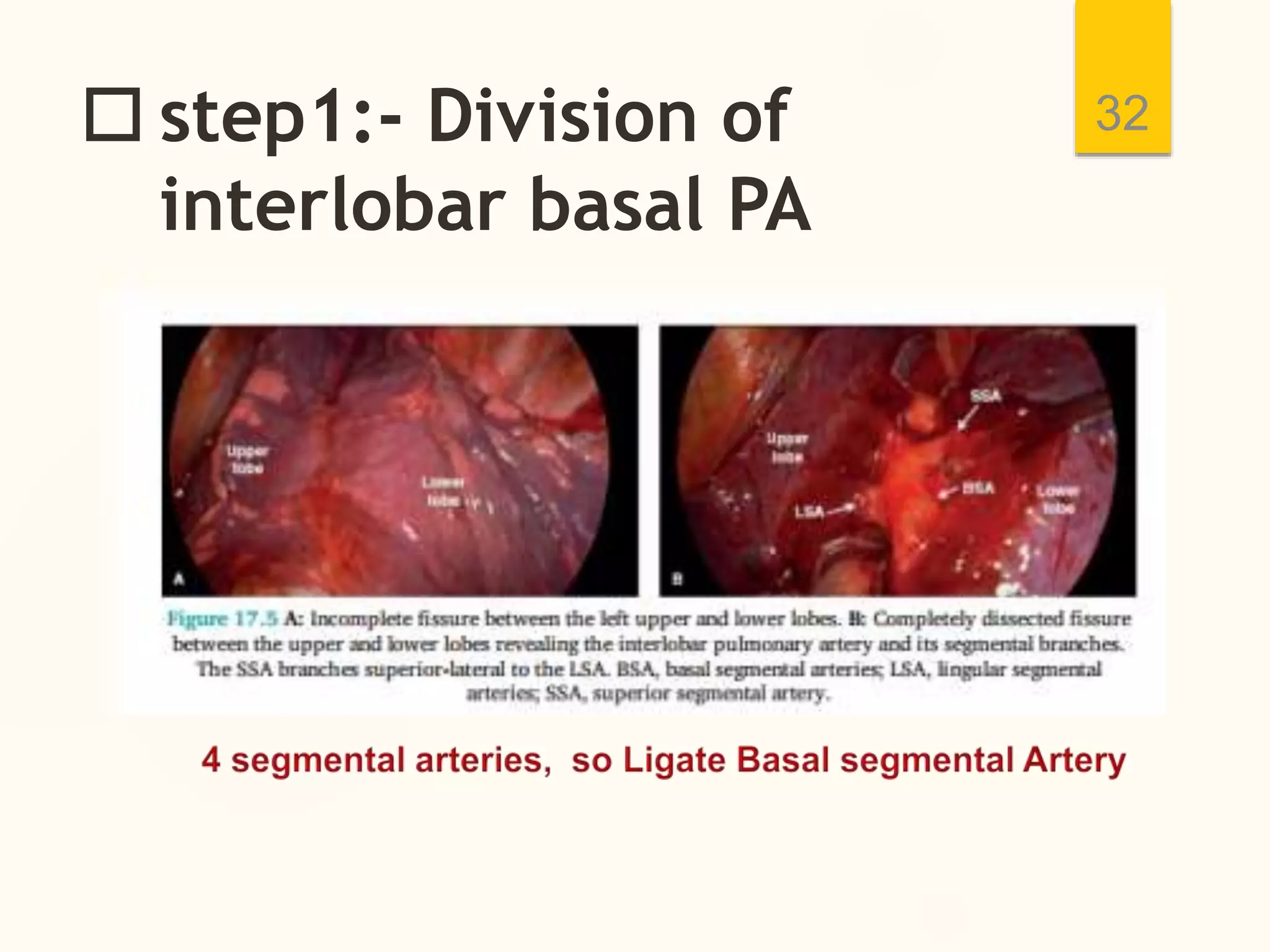  step1:- Division of
interlobar basal PA
32
 