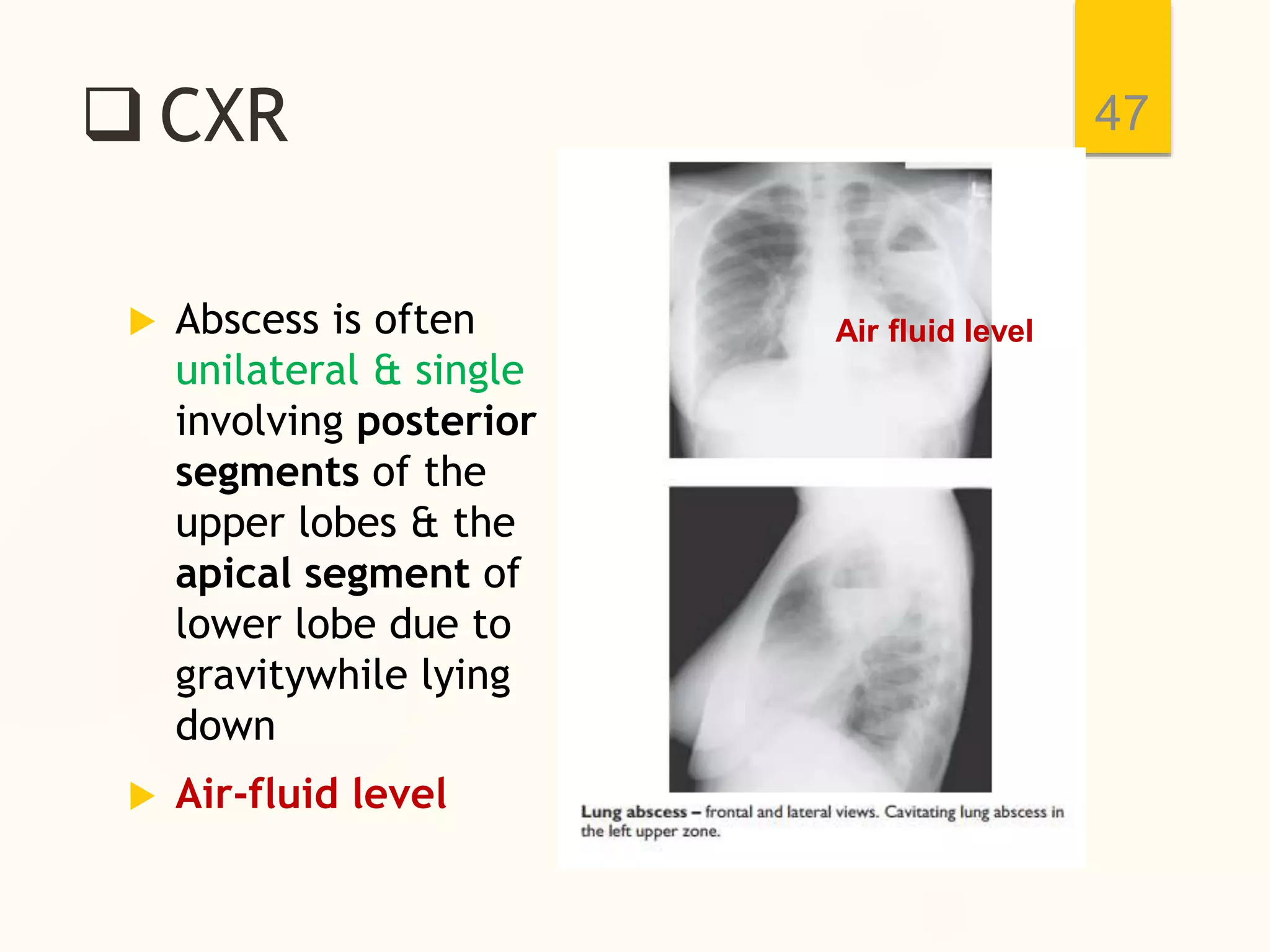  CXR
 Abscess is often
unilateral & single
involving posterior
segments of the
upper lobes & the
apical segment of
lower lobe due to
gravitywhile lying
down
 Air-fluid level
47
Air fluid level
 