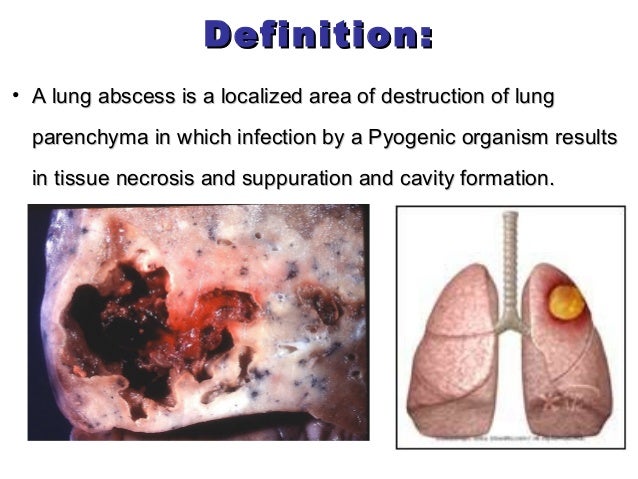 suppurative lung diseases