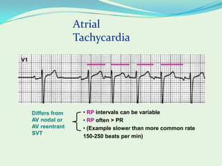 Svt In Normal R R Intervel Supra ventricular tachycardia | PPTX