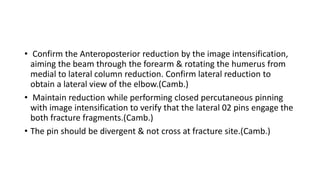 • Confirm the Anteroposterior reduction by the image intensification,
aiming the beam through the forearm & rotating the humerus from
medial to lateral column reduction. Confirm lateral reduction to
obtain a lateral view of the elbow.(Camb.)
• Maintain reduction while performing closed percutaneous pinning
with image intensification to verify that the lateral 02 pins engage the
both fracture fragments.(Camb.)
• The pin should be divergent & not cross at fracture site.(Camb.)
 
