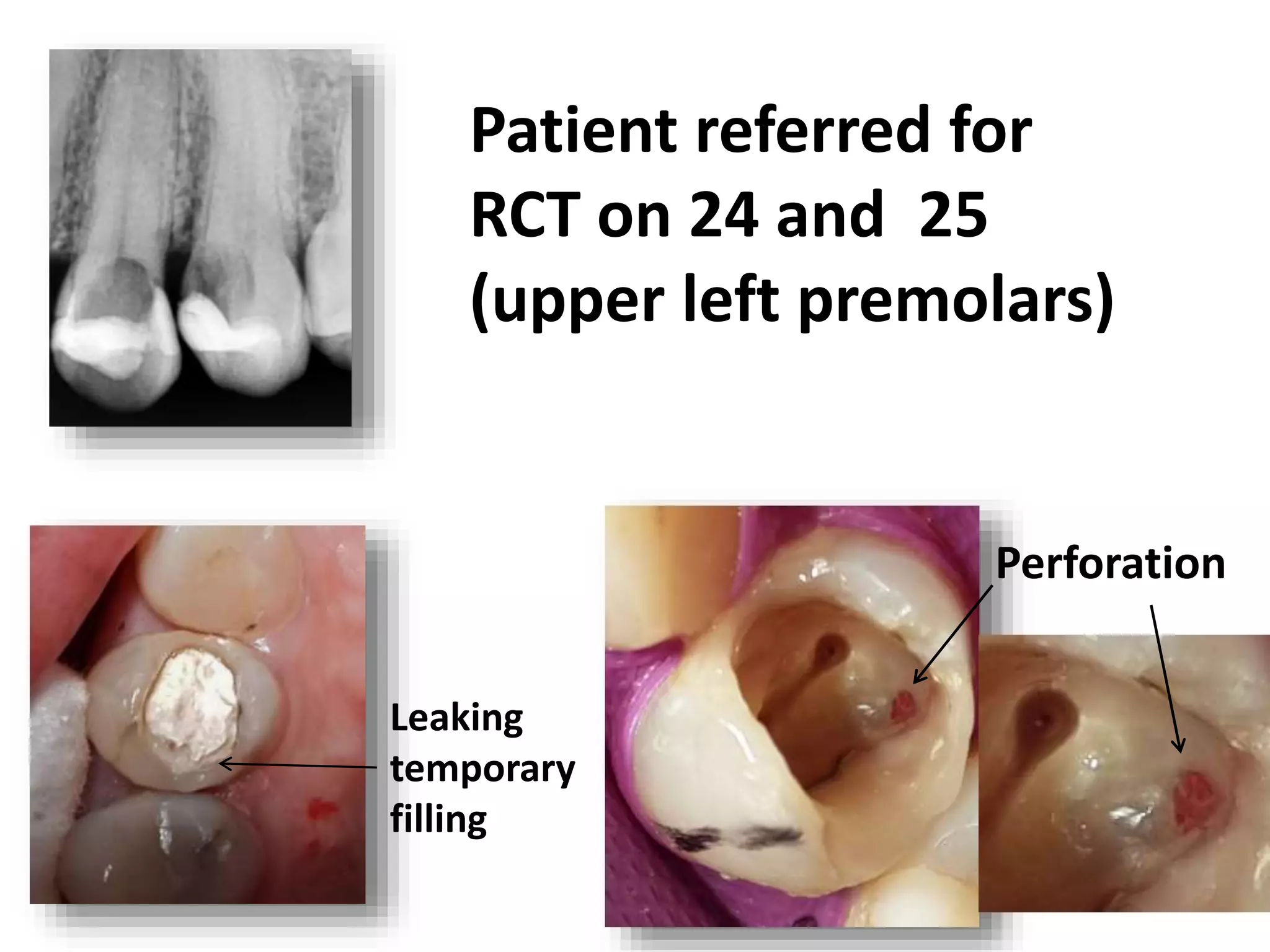 Upper Premolar Rct Supra crestal perforation repair, endodontics , mishaps | PPTX