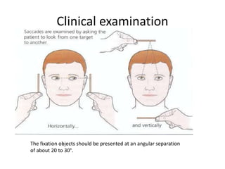 Clinical examination
The fixation objects should be presented at an angular separation
of about 20 to 30°.
 