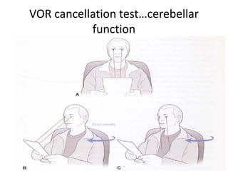 VOR cancellation test…cerebellar
function
• When a target moves with that of the head
movement VOR SUPRESSION is important for
precise foveation of the target
33
 
