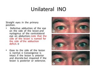 Unilateral INO
Straight eyes in the primary
position.
• Defective adduction of the eye
on the side of the lesion and
nystagmus of the contralateral
eye on abduction; note that the
side of the lesion is named for
the side of the adduction
deficit. ○
• Gaze to the side of the lesion
is normal. ○ Convergence is
intact if the lesion is anterior
and discrete but impaired if the
lesion is posterior or extensive.
 