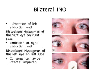 Bilateral INO
• Limitation of left
adduction and
Dissociated Nystagmus of
the right eye on right
gaze.
• Limitation of right
adduction and
Dissociated Nystagmus of
the left eye on left gaze.
• Convergence may be
intact Or impaired
 