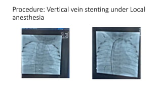 Procedure: Vertical vein stenting under Local
anesthesia
 