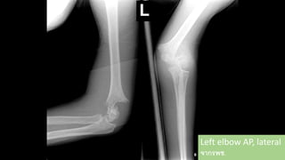 Left elbow AP, lateral
จากรพช.
 