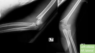 Left elbow
AP, lateral
 