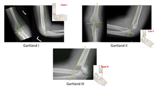 Gartland I Gartland II
Gartland III
 