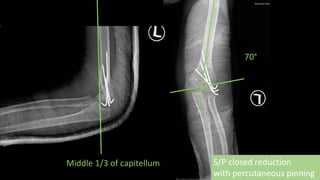 S/P closed reduction
with percutaneous pinning
70°
Middle 1/3 of capitellum
 