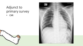 Adjunct to
primary survey
• CXR
 