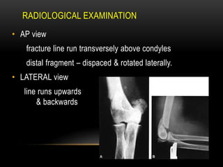 RADIOLOGICAL EXAMINATION
• AP view
fracture line run transversely above condyles
distal fragment – dispaced & rotated laterally.
• LATERAL view
line runs upwards
& backwards
 