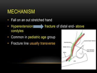 MECHANISM
• Fall on an out stretched hand
• Hyperextension fracture of distal end- above
condyles
• Common in pediatric age group
• Fracture line usually transverse
 