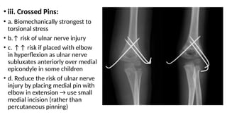 SUPRACONDYLAR FRACTURE - PAEDIATRIC.pptx