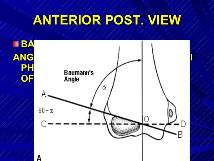 Supracondylar fractures in_children