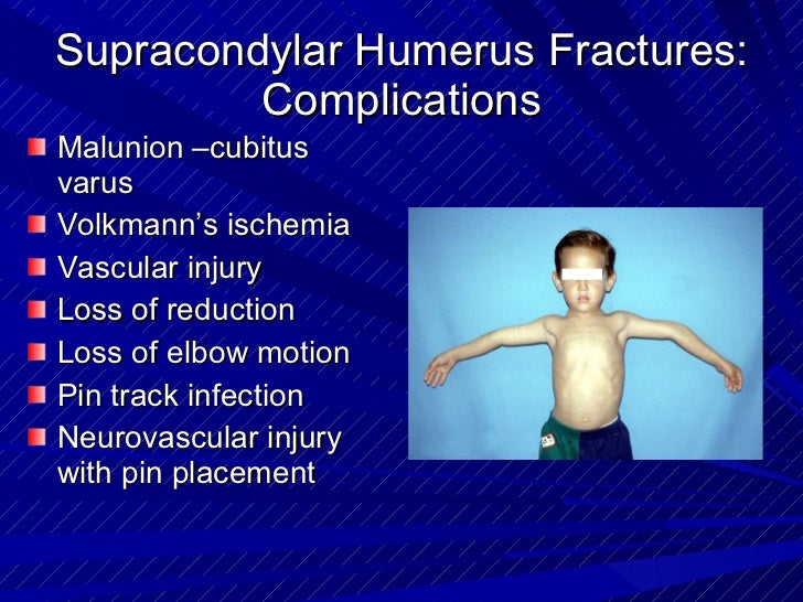 Supracondylar Fracture Brachial Artery Complications Of Supracondylar Supracondylar Fracture Brachial Artery Complications Of Supracondylar