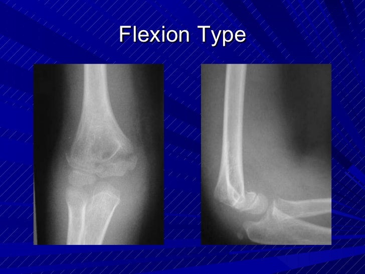 Supracondylar fractures in_children