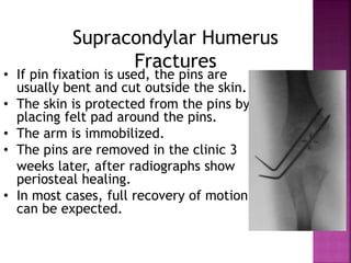 Supracondylar Humerus
Fractures: Indications for Open
Reduction• Inadequate
reduction with
closed methods
• Vascular injur...