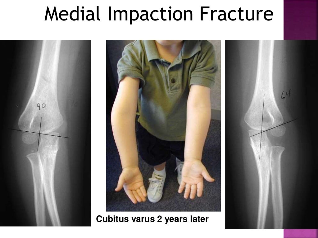 Supracondylar fractures in children