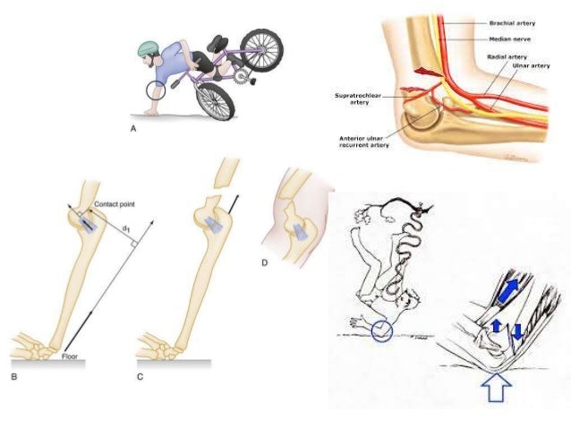 Supracondylar fractures in children