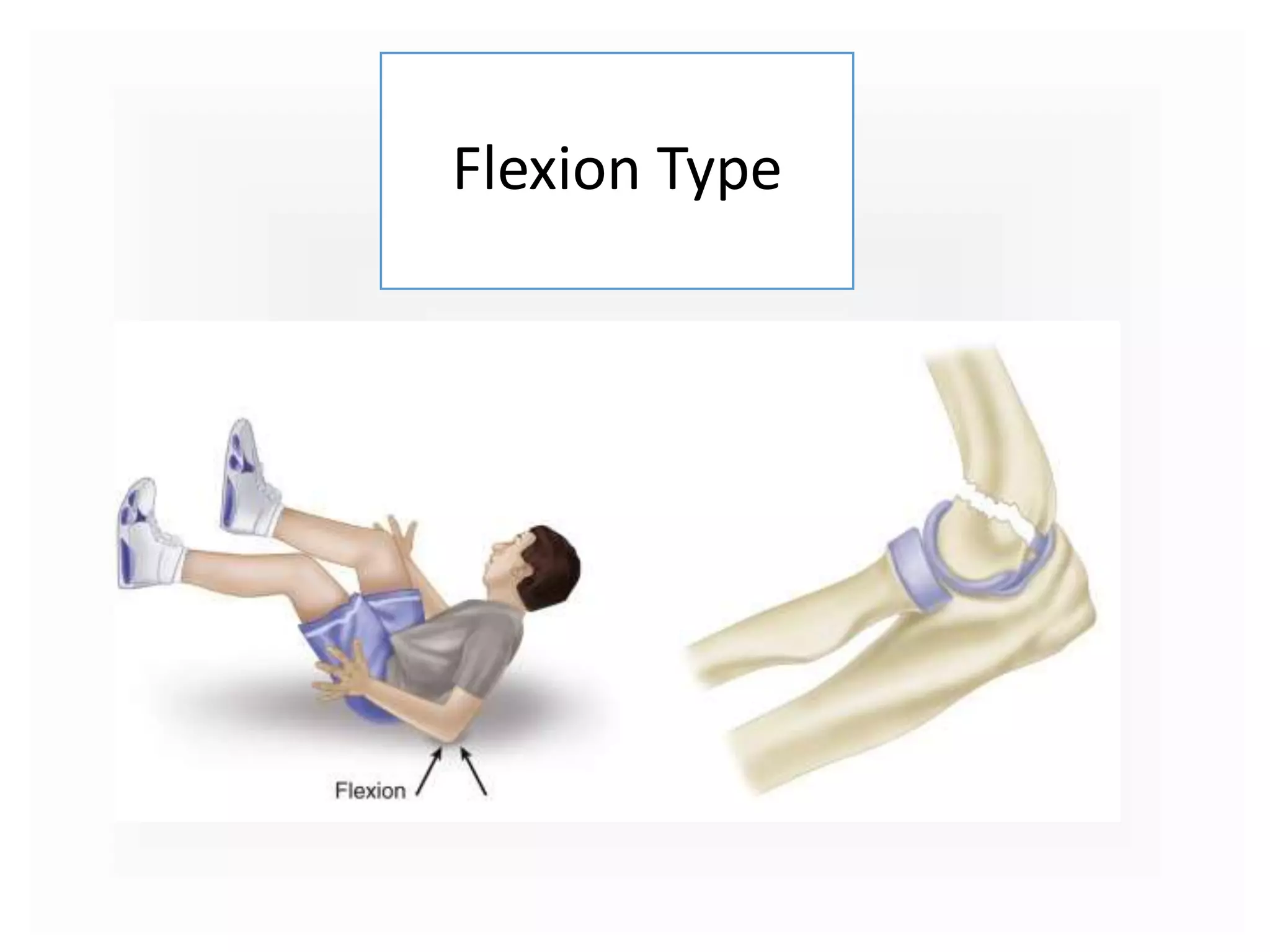 Flexion Type
 