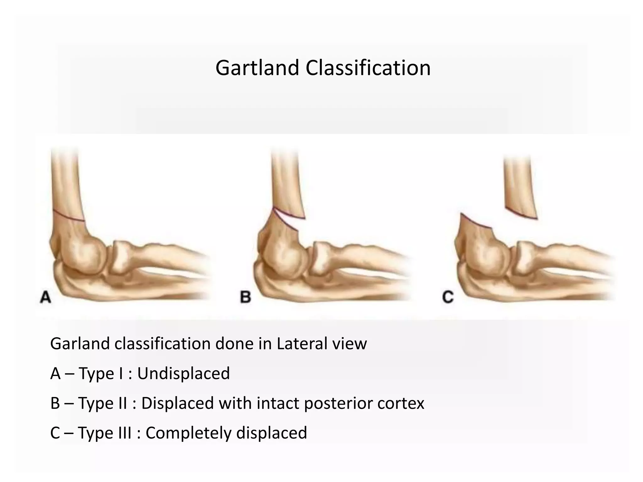 Gartland Classification
Garland classification done in Lateral view
A – Type I : Undisplaced
B – Type II : Displaced with intact posterior cortex
C – Type III : Completely displaced
 