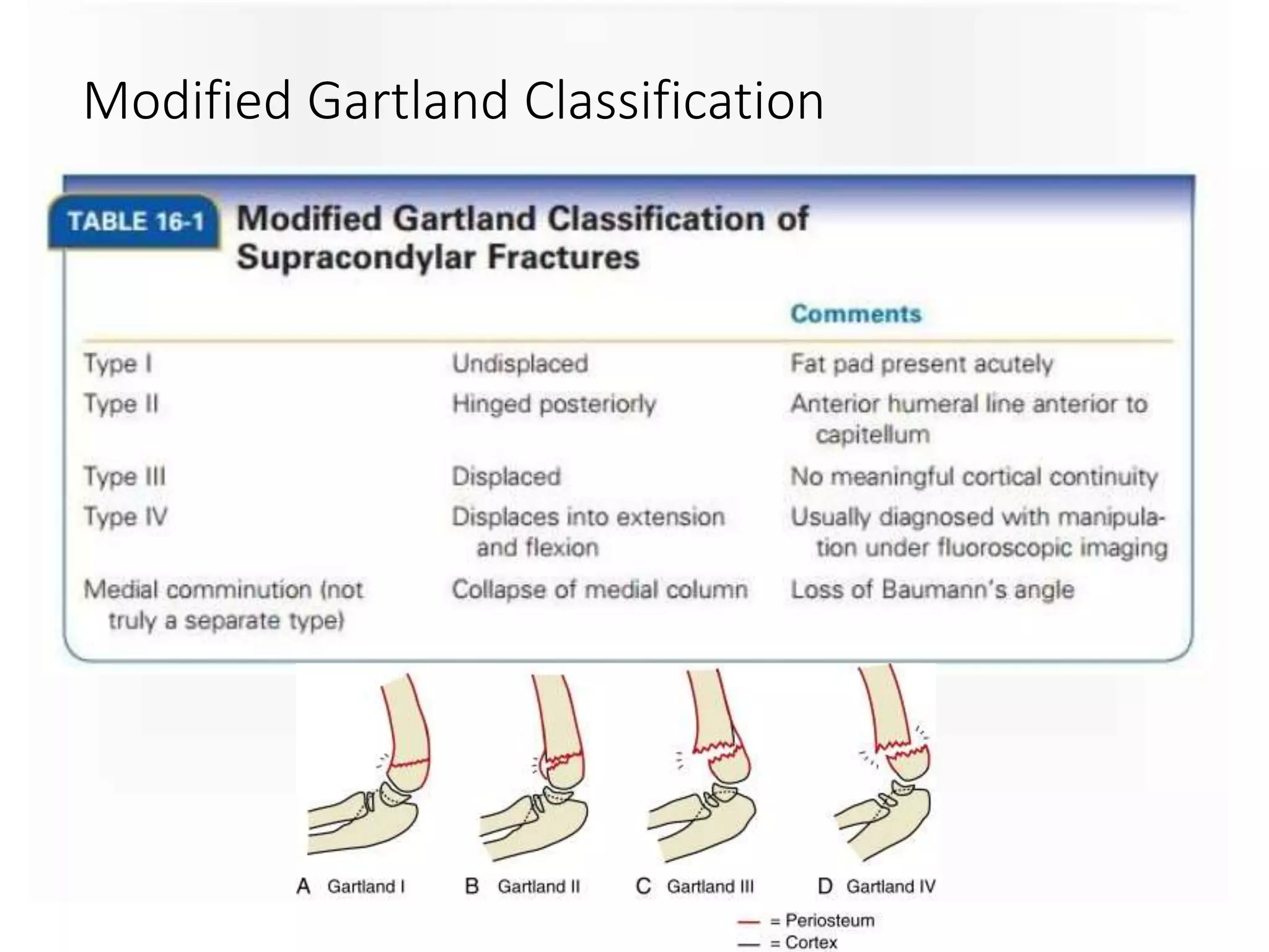 Modified Gartland Classification
 