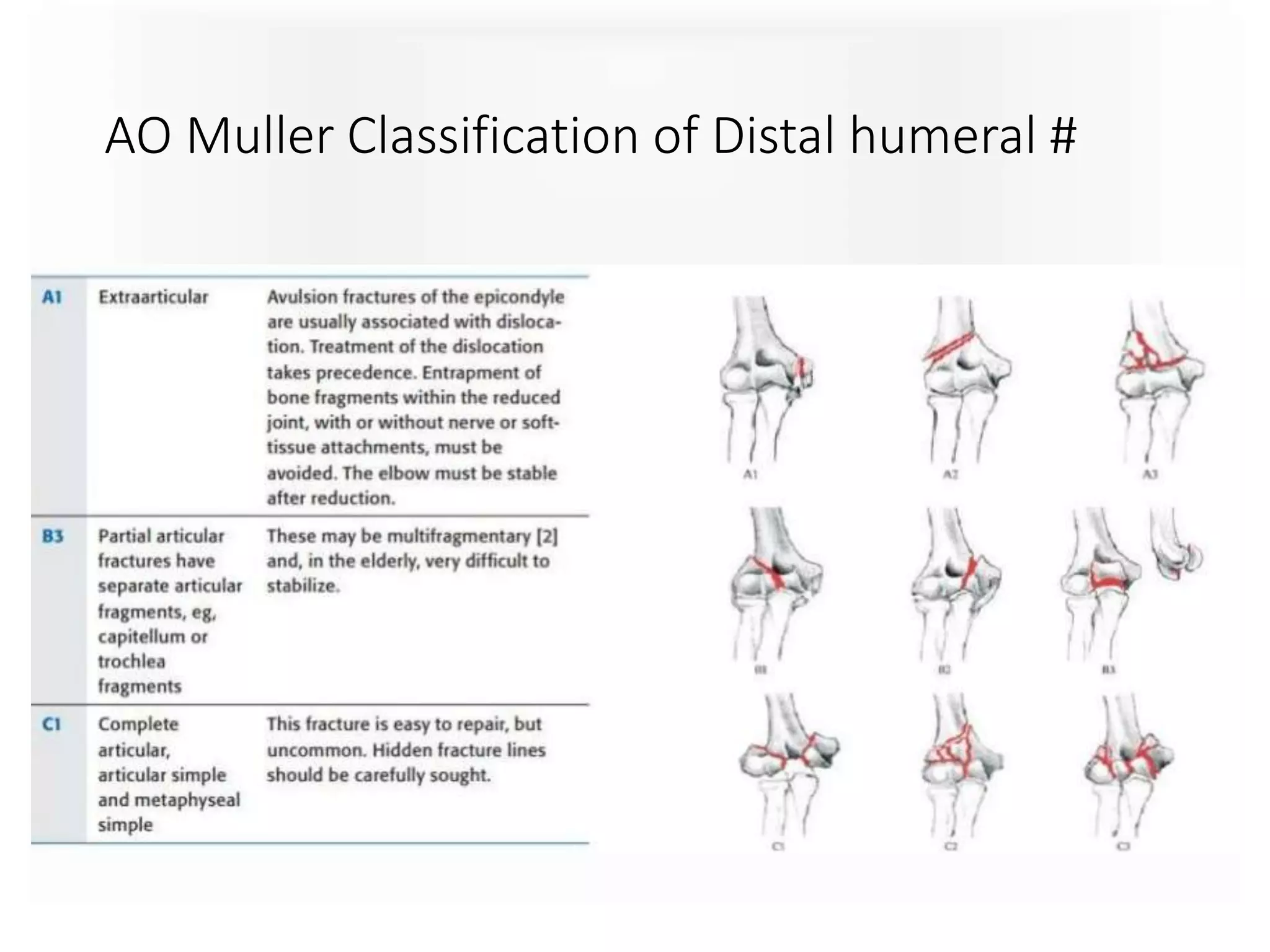 AO Muller Classification of Distal humeral #
 