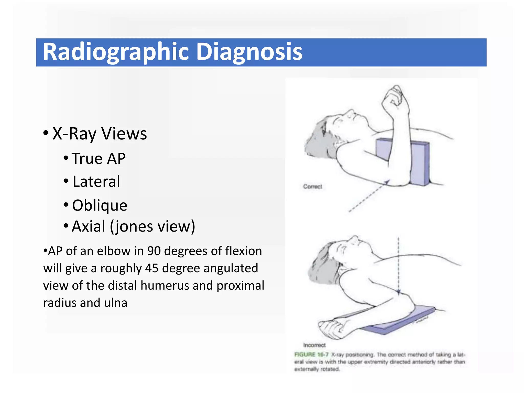 • X-Ray Views
•True AP
• Lateral
• Oblique
•Axial (jones view)
•AP of an elbow in 90 degrees of flexion
will give a roughly 45 degree angulated
view of the distal humerus and proximal
radius and ulna
Radiographic Diagnosis
 