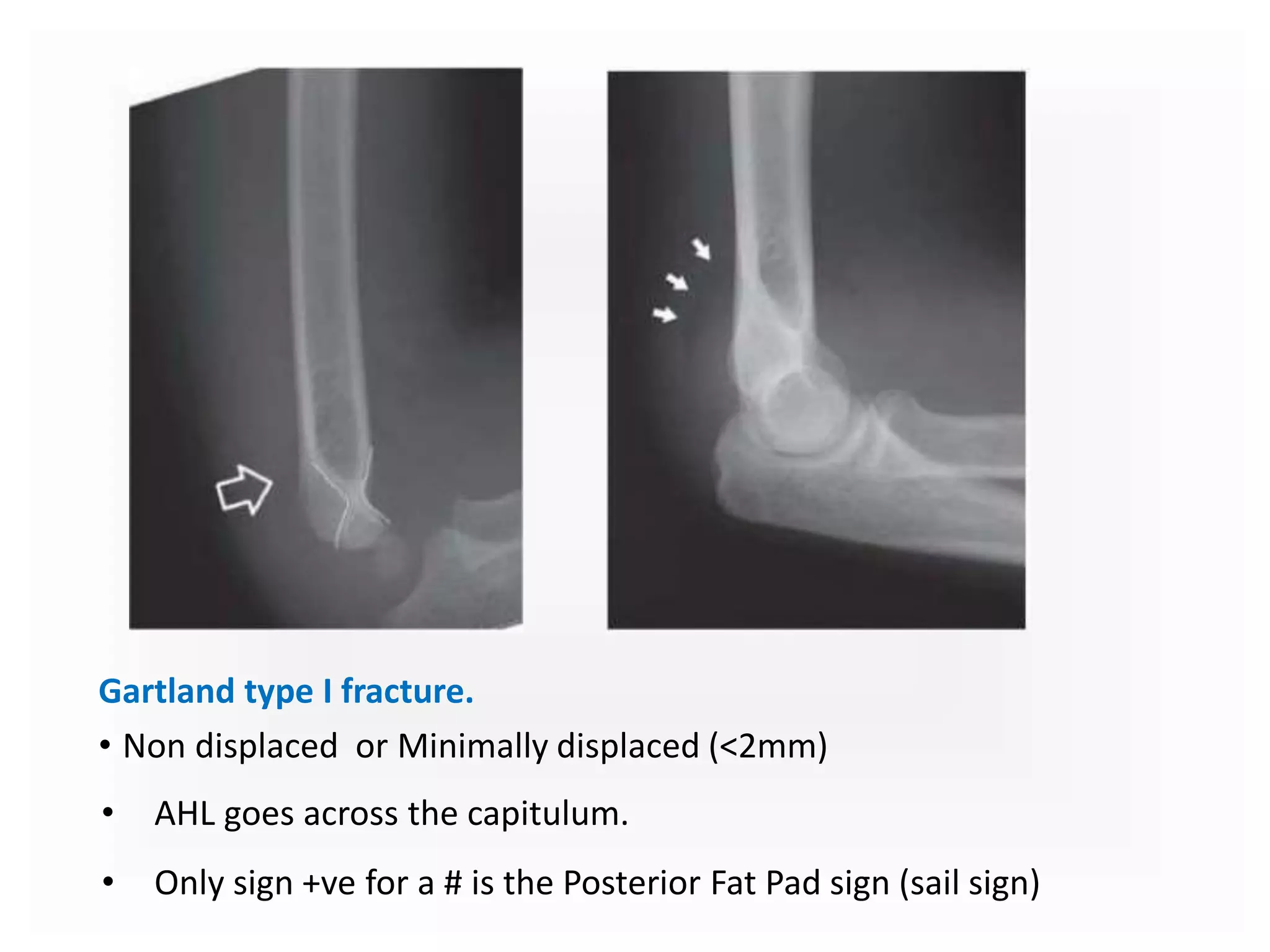 Gartland type I fracture.
• Non displaced or Minimally displaced (<2mm)
• AHL goes across the capitulum.
• Only sign +ve for a # is the Posterior Fat Pad sign (sail sign)
 