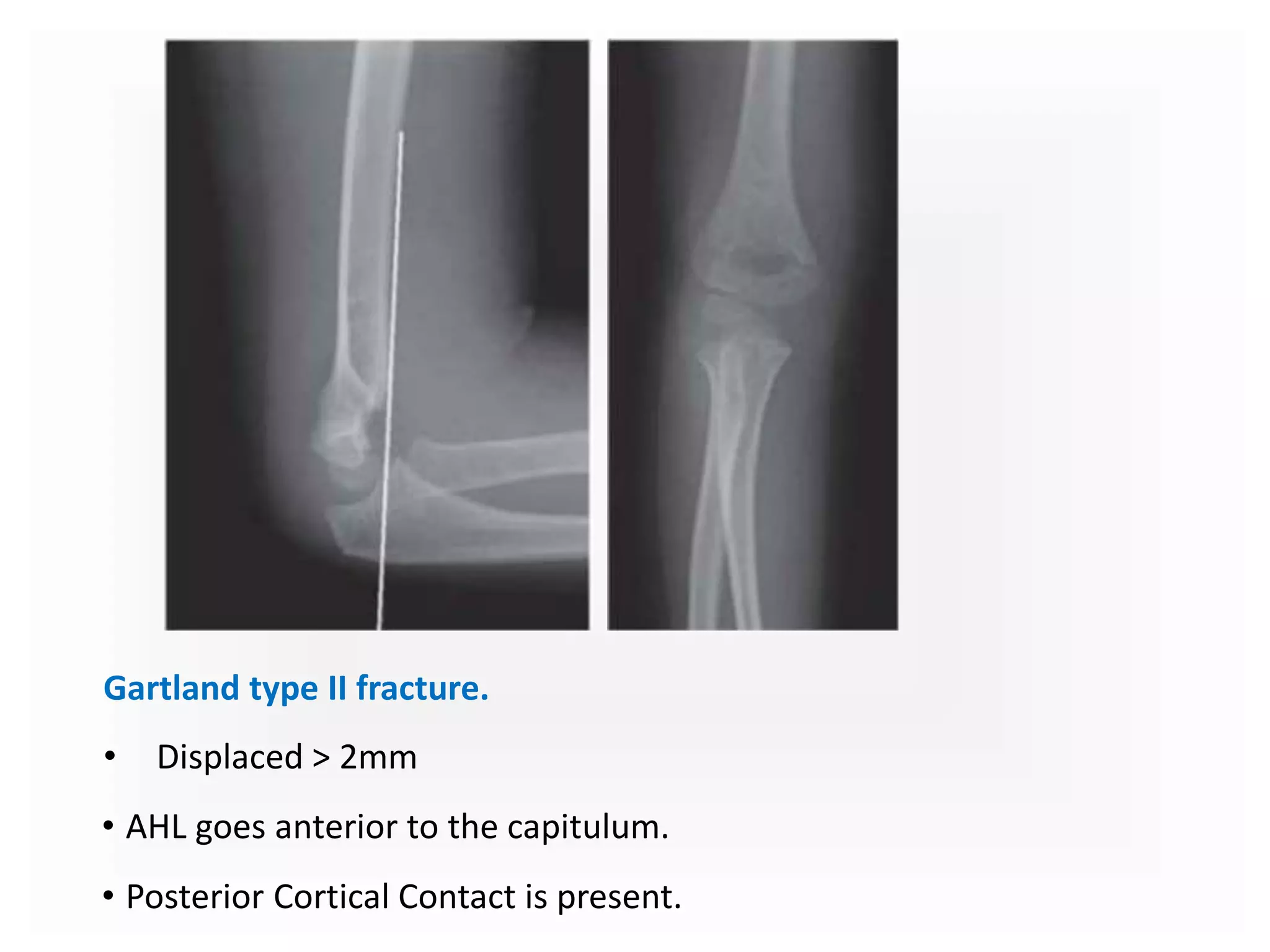 Gartland type II fracture.
• Displaced > 2mm
• AHL goes anterior to the capitulum.
• Posterior Cortical Contact is present.
 