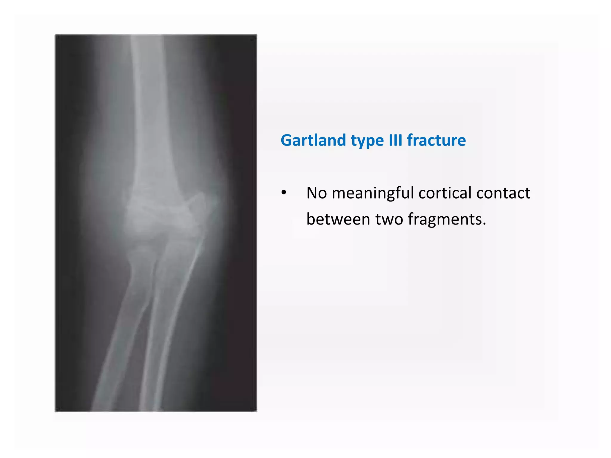 Gartland type III fracture
• No meaningful cortical contact
between two fragments.
 
