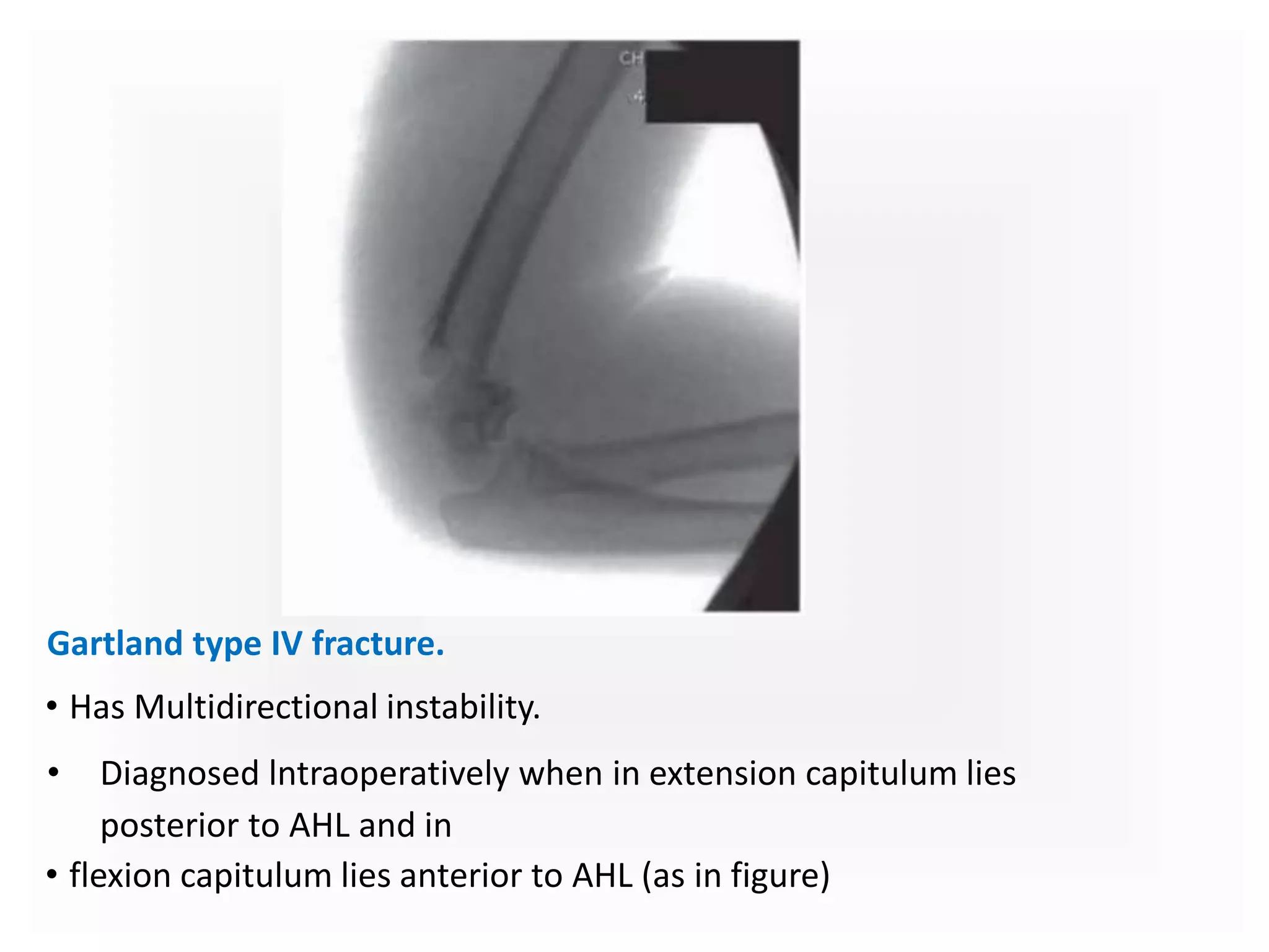 Gartland type IV fracture.
• Has Multidirectional instability.
• Diagnosed lntraoperatively when in extension capitulum lies
posterior to AHL and in
• flexion capitulum lies anterior to AHL (as in figure)
 