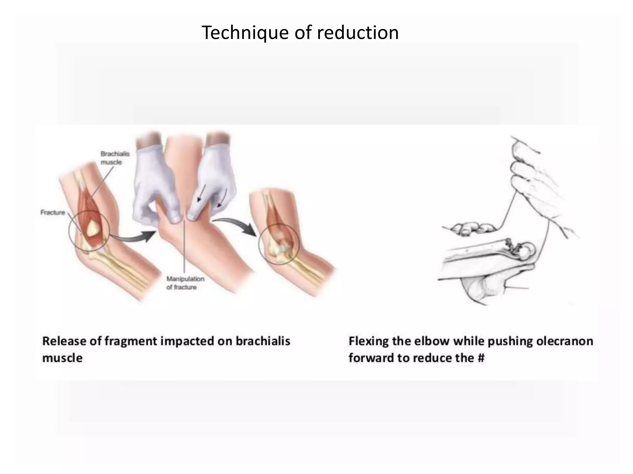 Technique of reduction
 