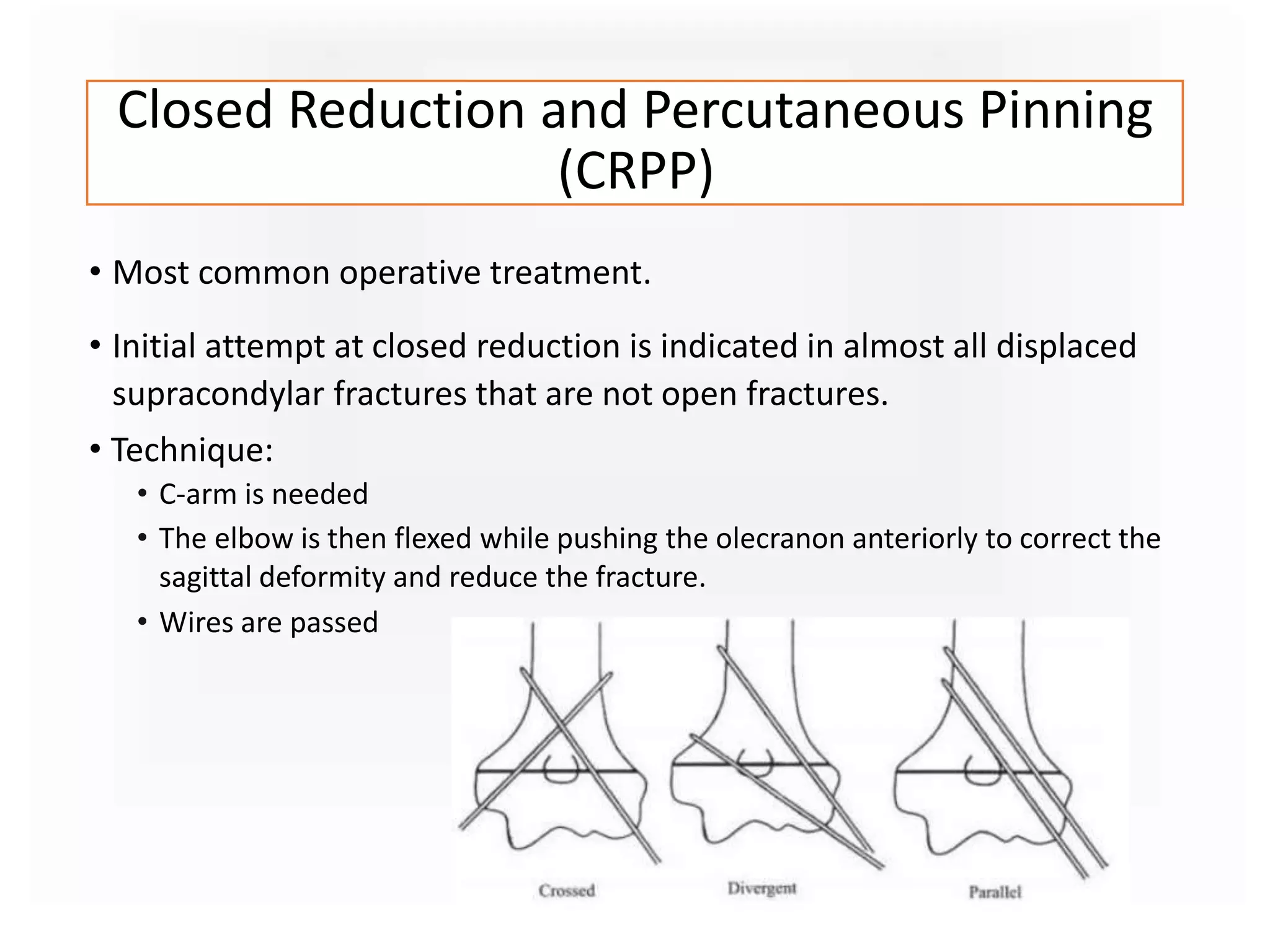 Closed Reduction and Percutaneous Pinning
(CRPP)
• Most common operative treatment.
• Initial attempt at closed reduction is indicated in almost all displaced
supracondylar fractures that are not open fractures.
• Technique:
• C-arm is needed
• The elbow is then flexed while pushing the olecranon anteriorly to correct the
sagittal deformity and reduce the fracture.
• Wires are passed
 