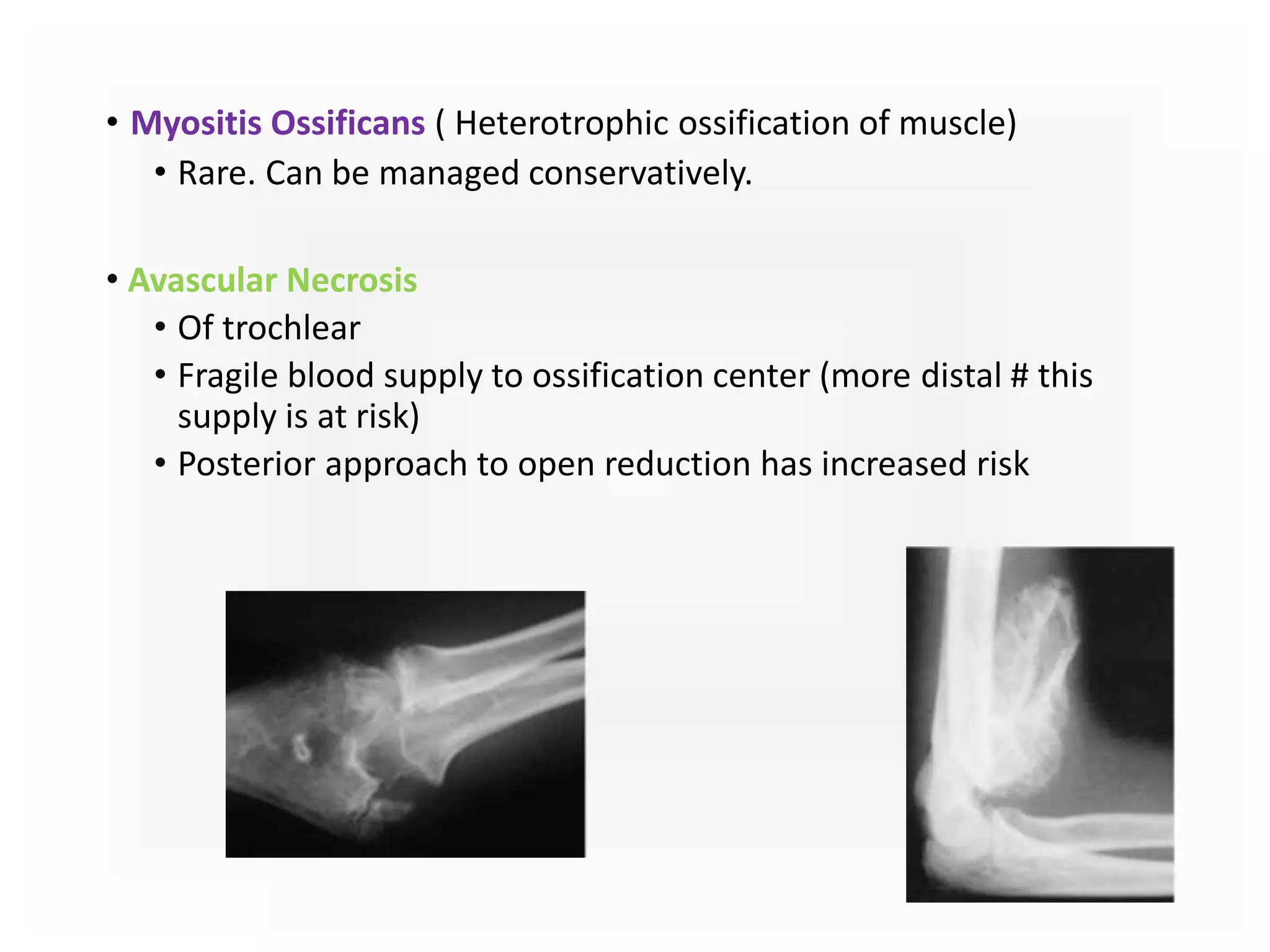 • Myositis Ossificans ( Heterotrophic ossification of muscle)
• Rare. Can be managed conservatively.
• Avascular Necrosis
• Of trochlear
• Fragile blood supply to ossification center (more distal # this
supply is at risk)
• Posterior approach to open reduction has increased risk
 