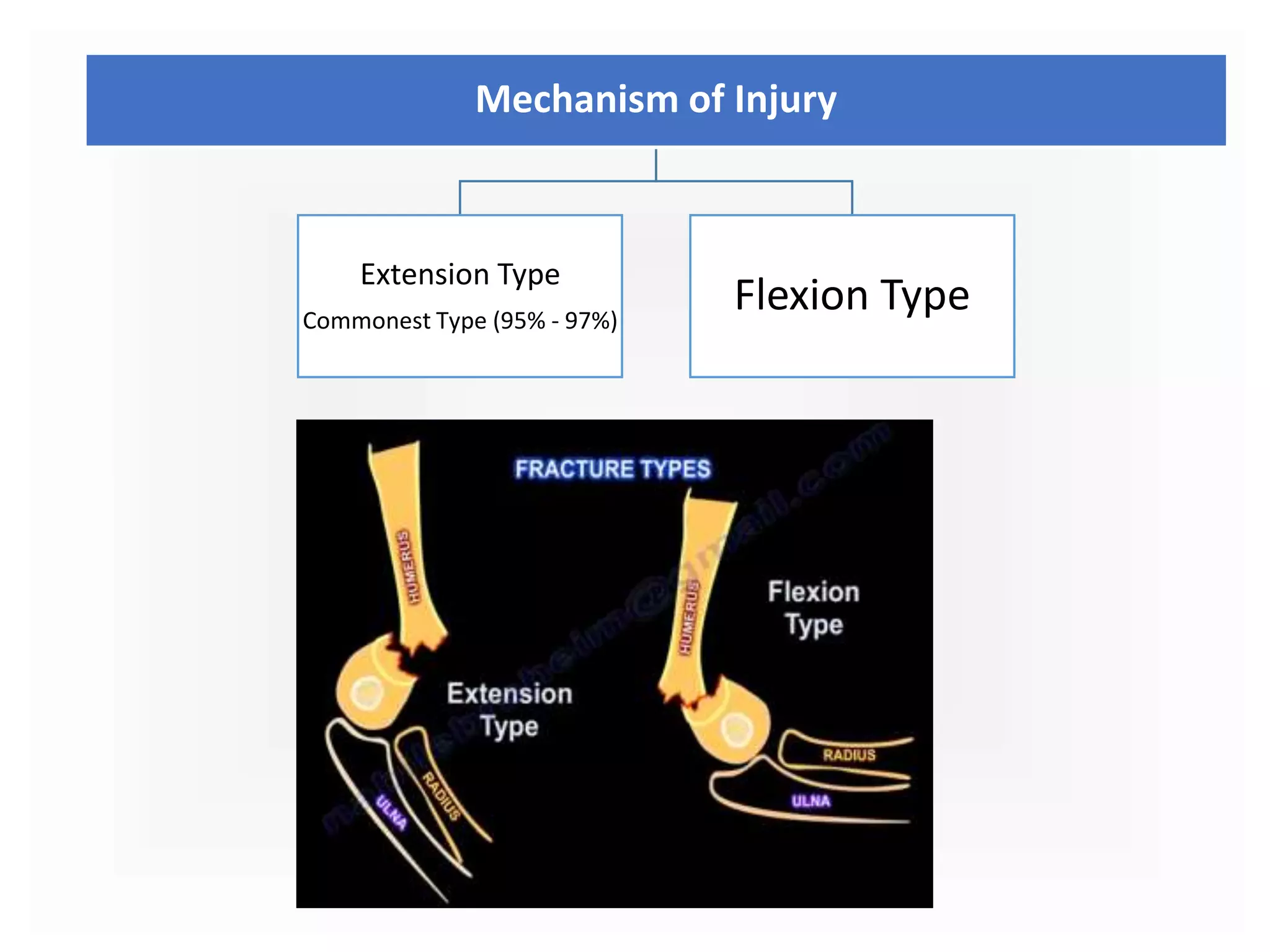 Mechanism of Injury
Extension Type
Commonest Type (95% - 97%)
Flexion Type
 