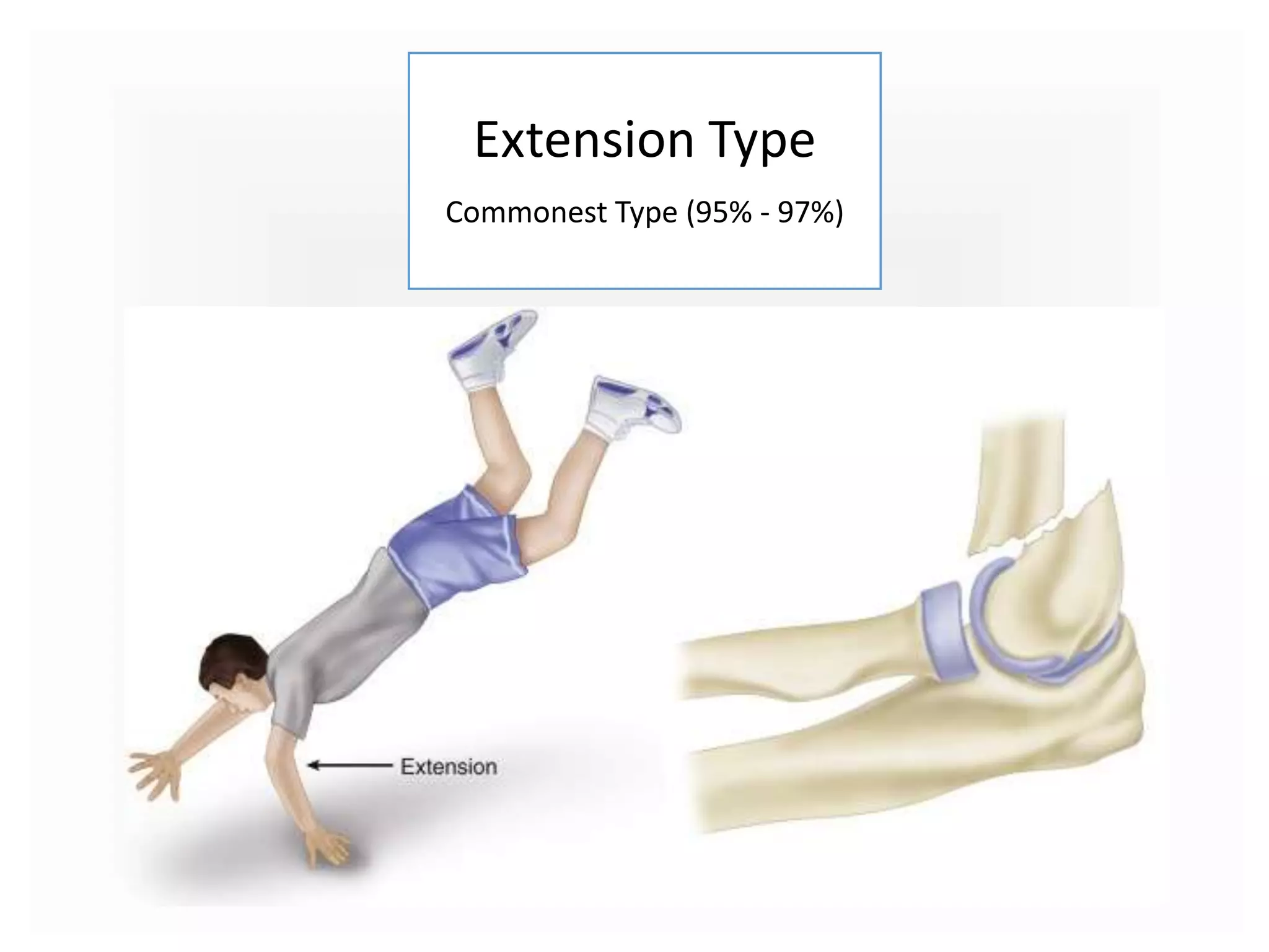 Extension Type
Commonest Type (95% - 97%)
 