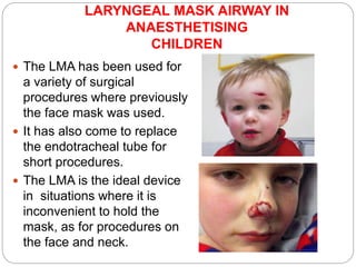 LARYNGEAL MASK AIRWAY IN
ANAESTHETISING
CHILDREN
 The LMA has been used for
a variety of surgical
procedures where previously
the face mask was used.
 It has also come to replace
the endotracheal tube for
short procedures.
 The LMA is the ideal device
in situations where it is
inconvenient to hold the
mask, as for procedures on
the face and neck.
 