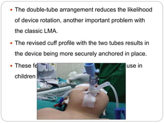  The double-tube arrangement reduces the likelihood
of device rotation, another important problem with
the classic LMA.
 The revised cuff profile with the two tubes results in
the device being more securely anchored in place.
 These features make the Proseal ideal for use in
children
 