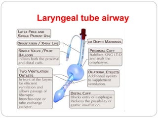 Laryngeal tube airway
 