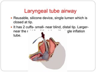 Laryngeal tube airway
 Reusable, silicone device, single lumen which is
closed at tip.
 It has 2 cuffs- small- near blind, distal tip. Larger-
near the middle of the tube with single inflation
tube.
 