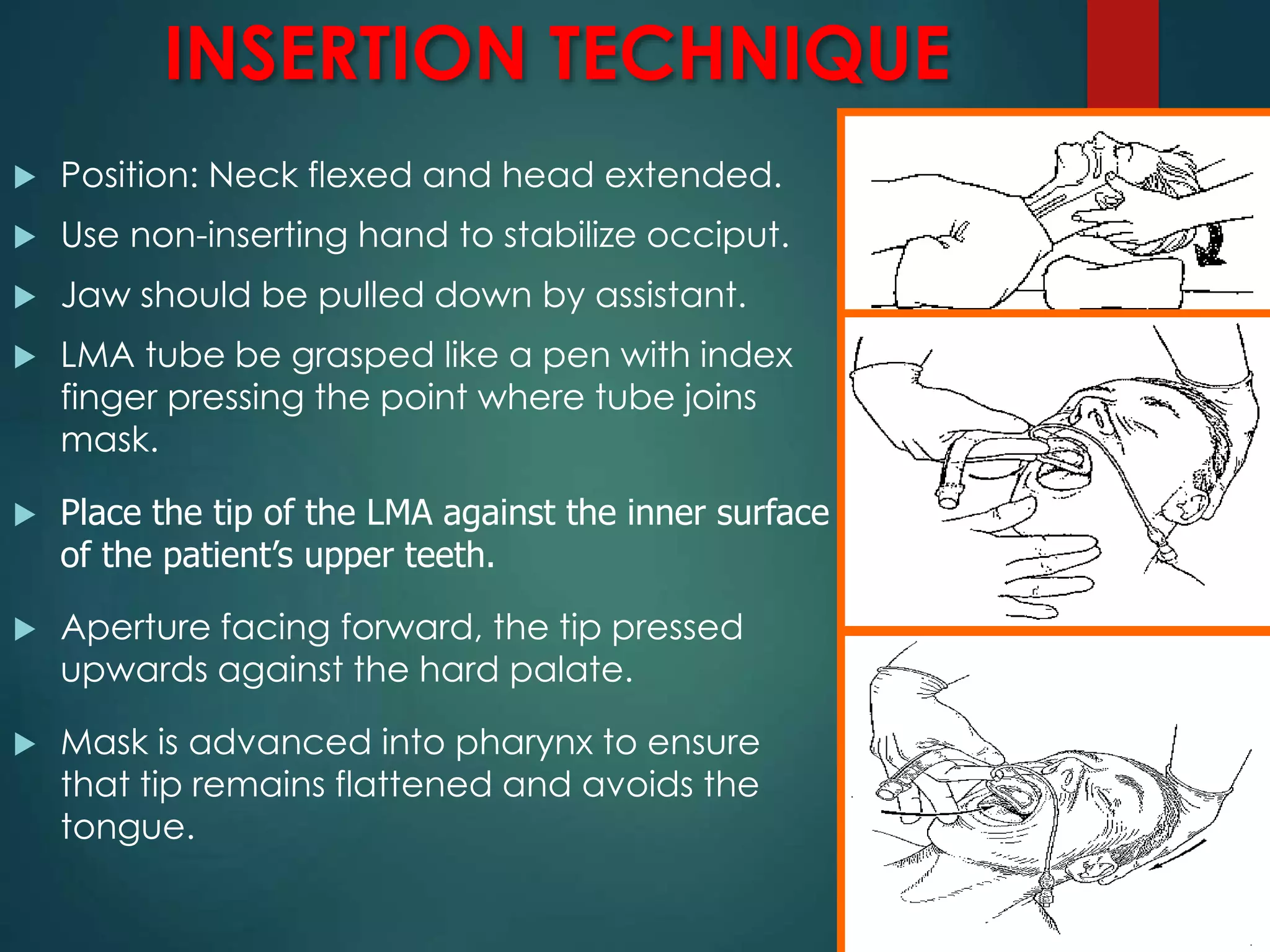 INSERTION TECHNIQUE
 Position: Neck flexed and head extended.
 Use non-inserting hand to stabilize occiput.
 Jaw should be pulled down by assistant.
 LMA tube be grasped like a pen with index
finger pressing the point where tube joins
mask.
 Place the tip of the LMA against the inner surface
of the patient’s upper teeth.
 Aperture facing forward, the tip pressed
upwards against the hard palate.
 Mask is advanced into pharynx to ensure
that tip remains flattened and avoids the
tongue.
 