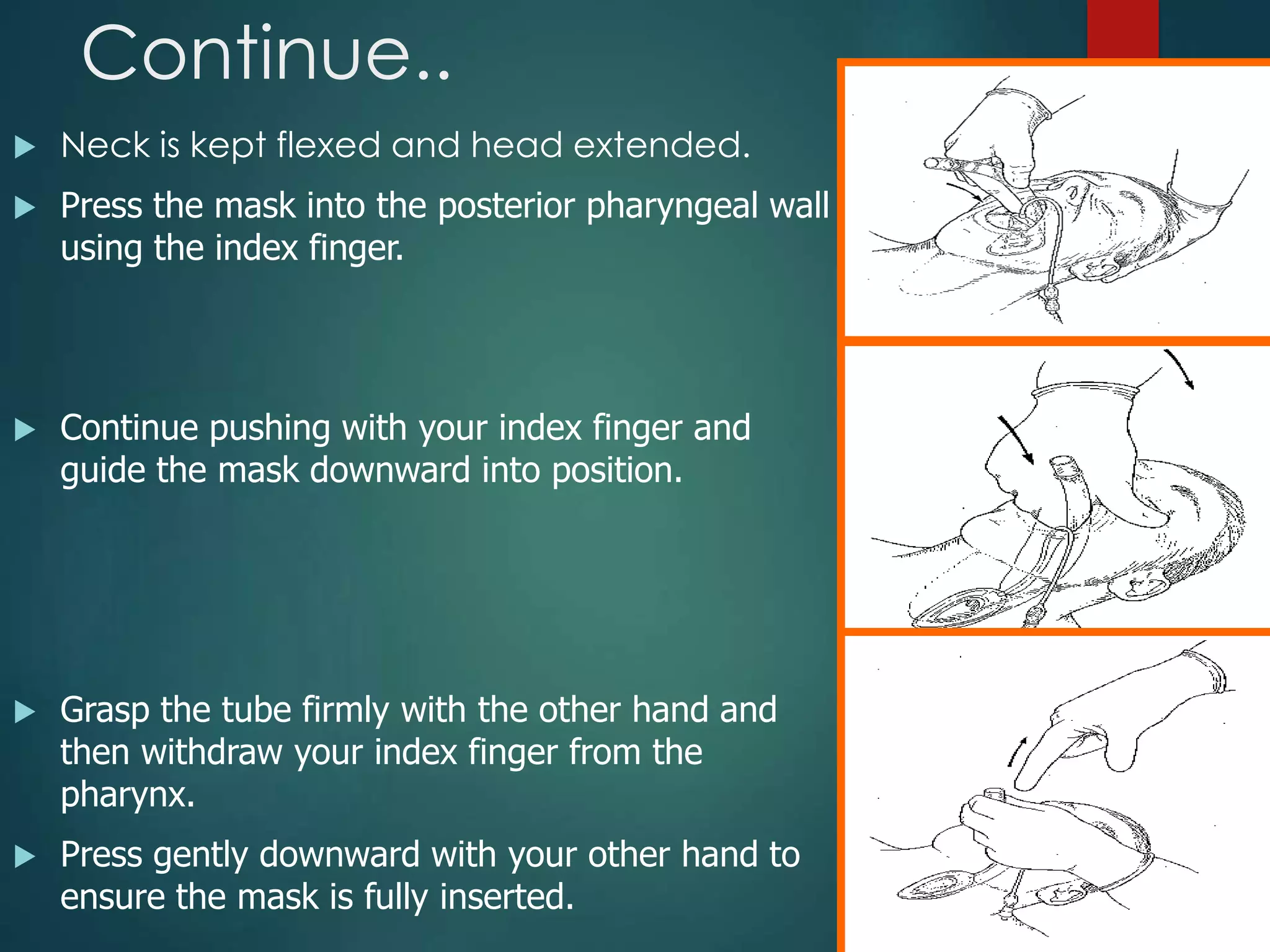 Continue..
 Neck is kept flexed and head extended.
 Press the mask into the posterior pharyngeal wall
using the index finger.
 Continue pushing with your index finger and
guide the mask downward into position.
 Grasp the tube firmly with the other hand and
then withdraw your index finger from the
pharynx.
 Press gently downward with your other hand to
ensure the mask is fully inserted.
 
