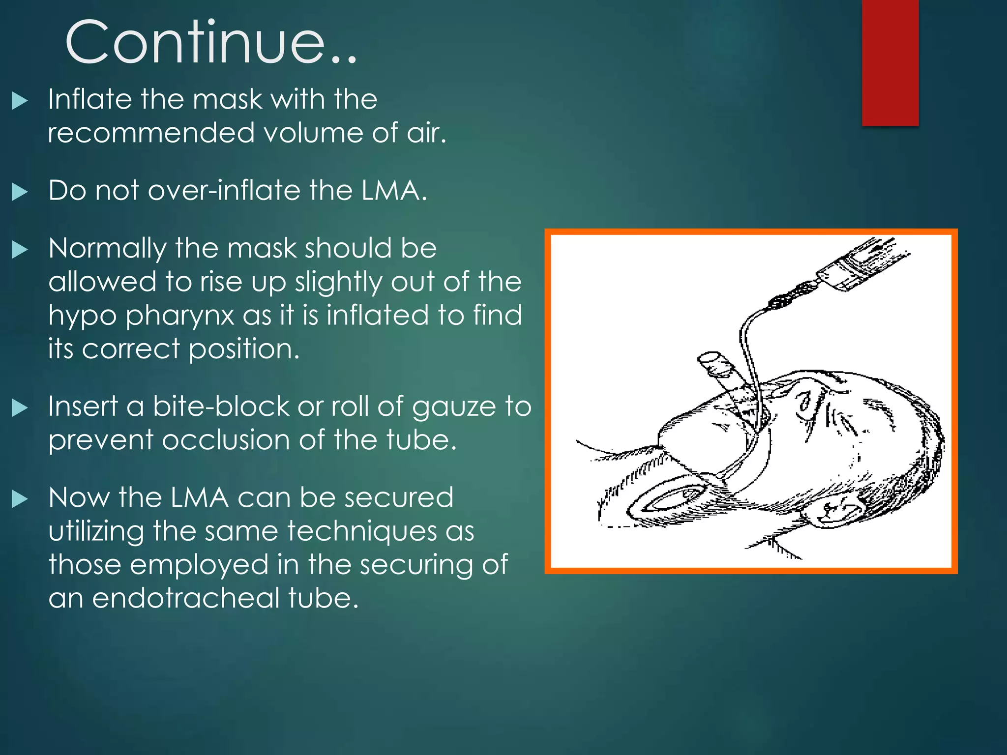 Continue..
 Inflate the mask with the
recommended volume of air.
 Do not over-inflate the LMA.
 Normally the mask should be
allowed to rise up slightly out of the
hypo pharynx as it is inflated to find
its correct position.
 Insert a bite-block or roll of gauze to
prevent occlusion of the tube.
 Now the LMA can be secured
utilizing the same techniques as
those employed in the securing of
an endotracheal tube.
 